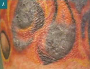 It’s Terrifying To Think About It: Can A Tattoo Be Infected Like This? ? ?